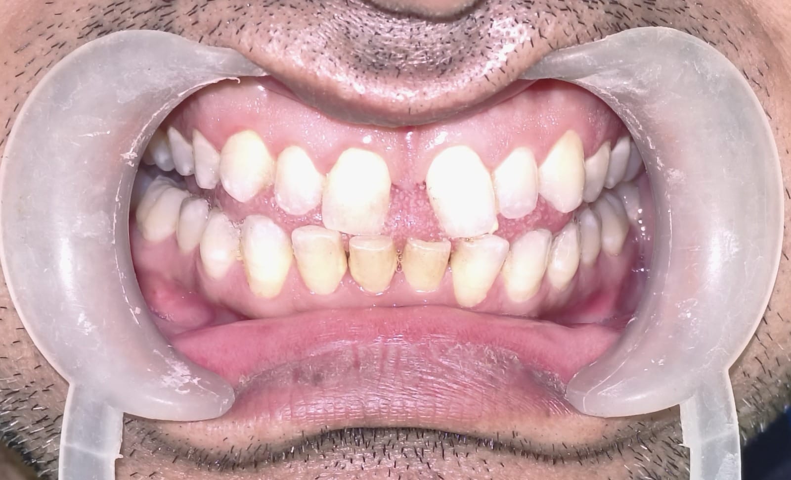 Dental treatment before