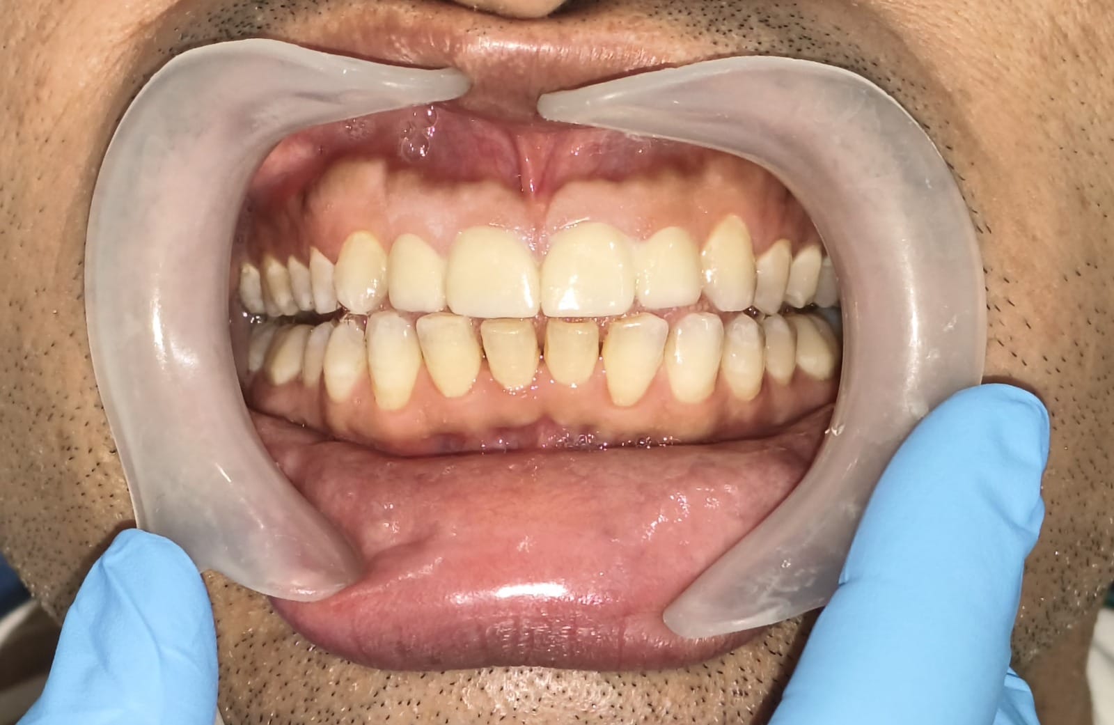 Dental treatment after