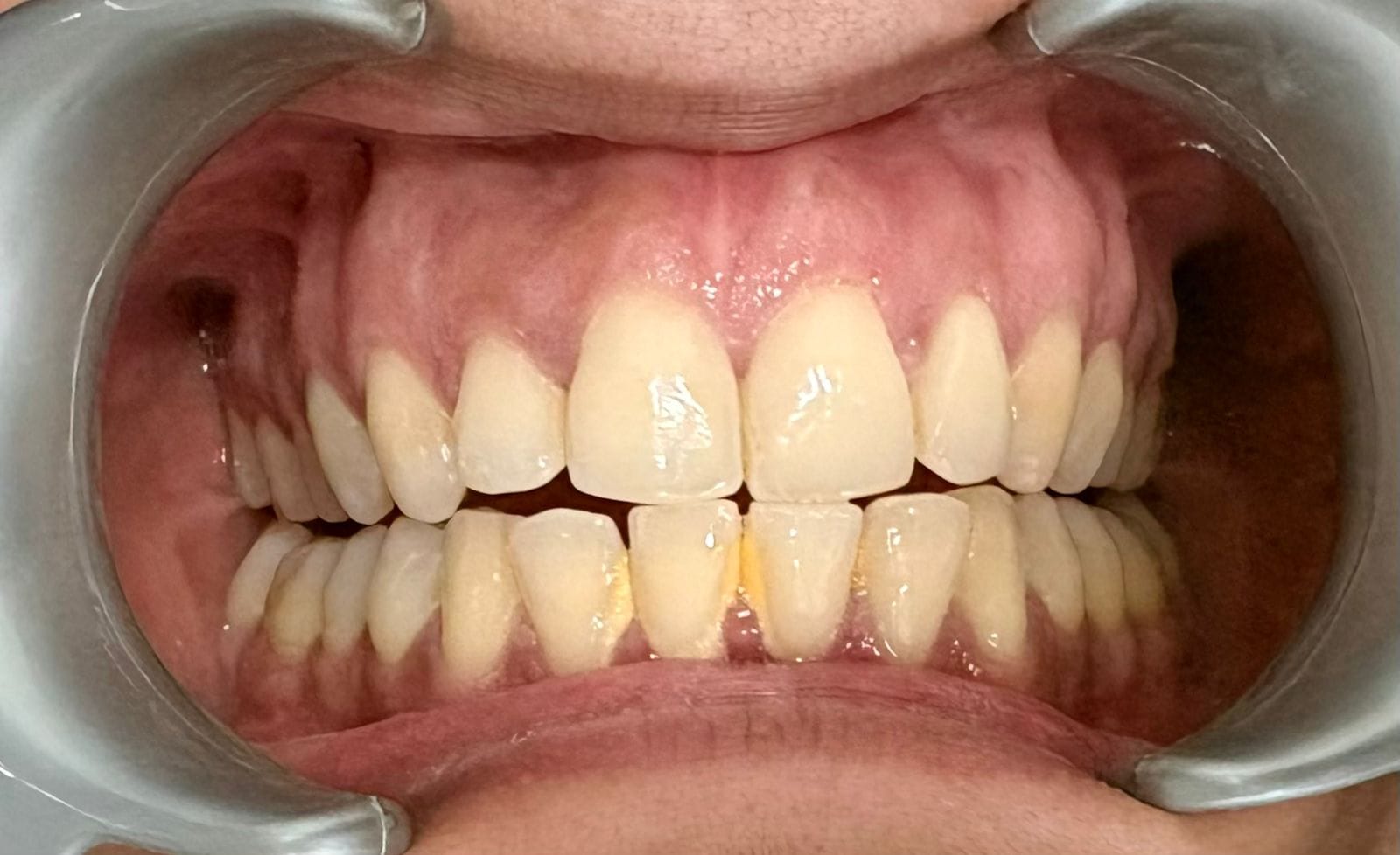 Dental treatment before