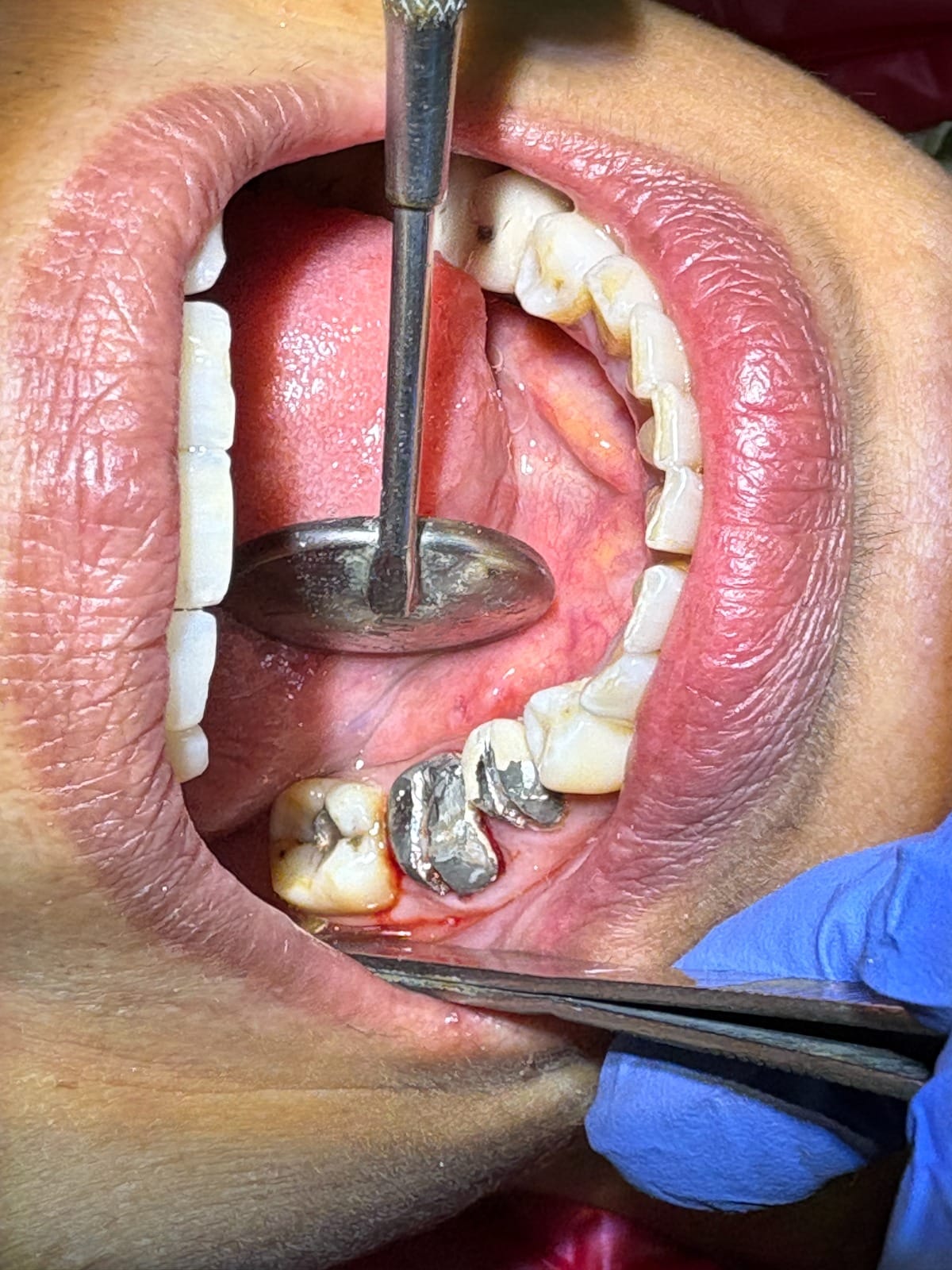 Dental treatment before