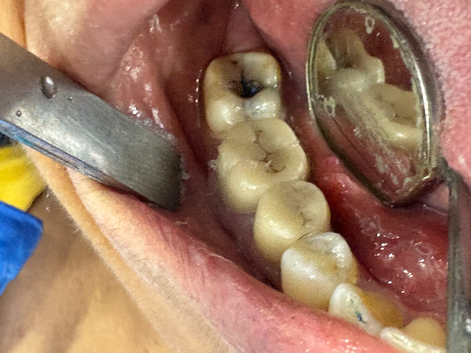Dental treatment after