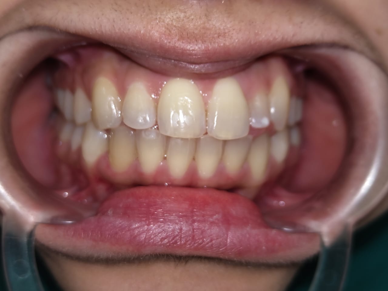 Dental treatment before