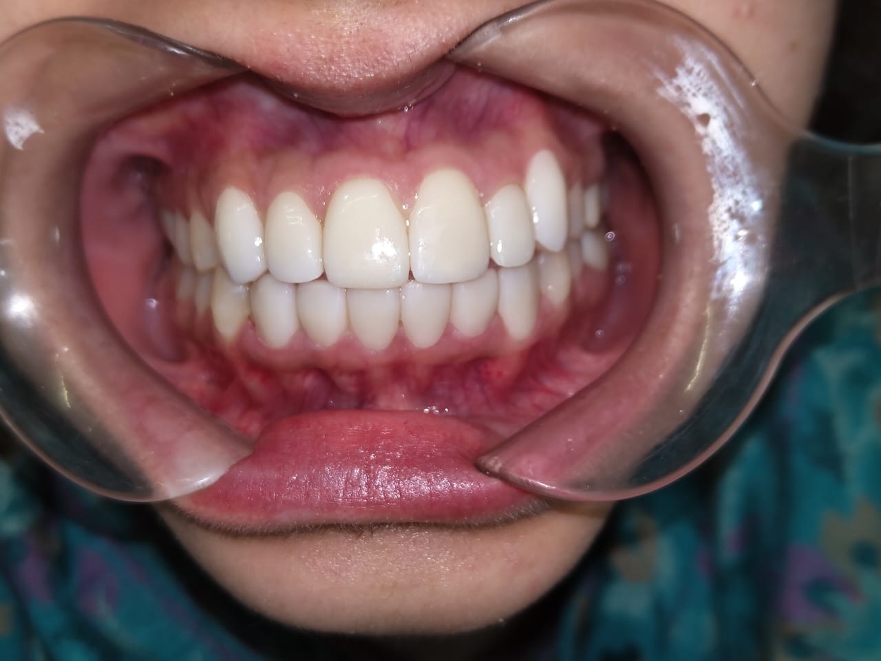 Dental treatment after