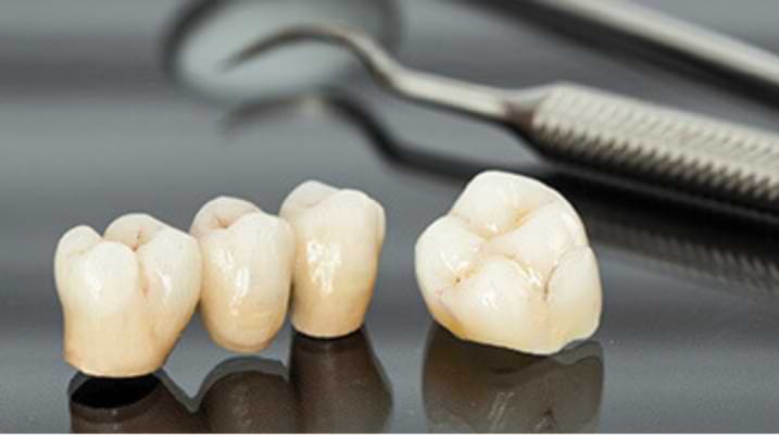 Dental crown and bridge treatment