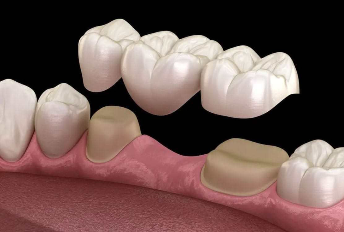 Dental Crowns & Bridges