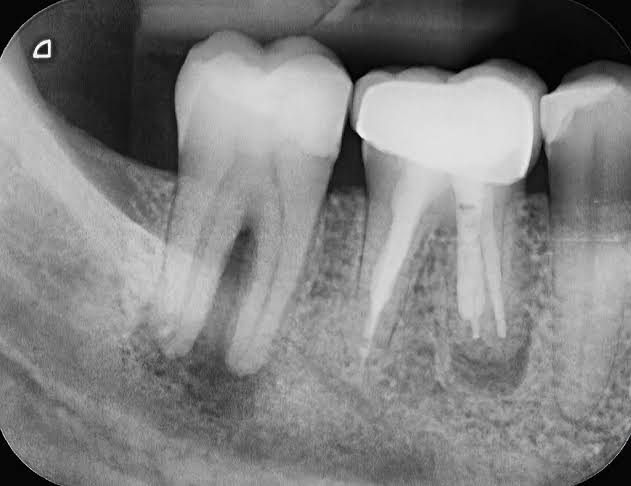 Dental abscess and infection