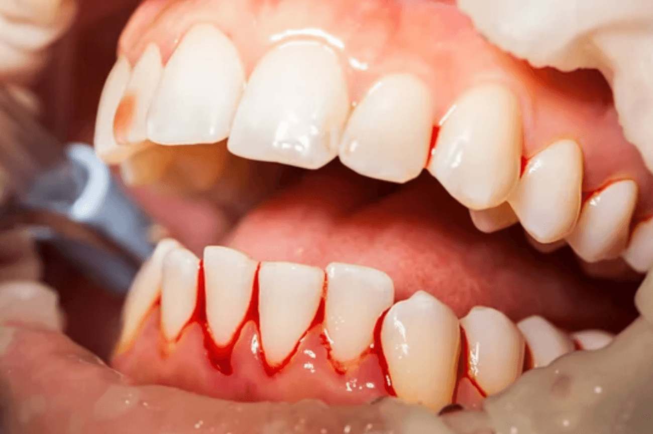 Bleeding gums and gum problems