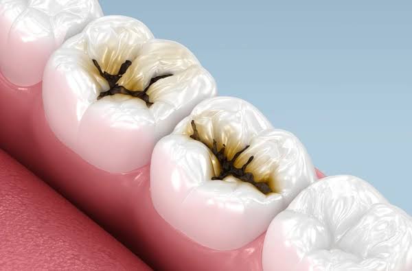Dental cavity and tooth decay