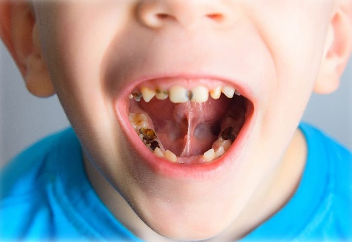 Child dental caries
