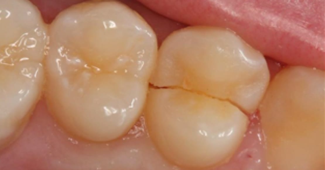 Cracked tooth dental emergency