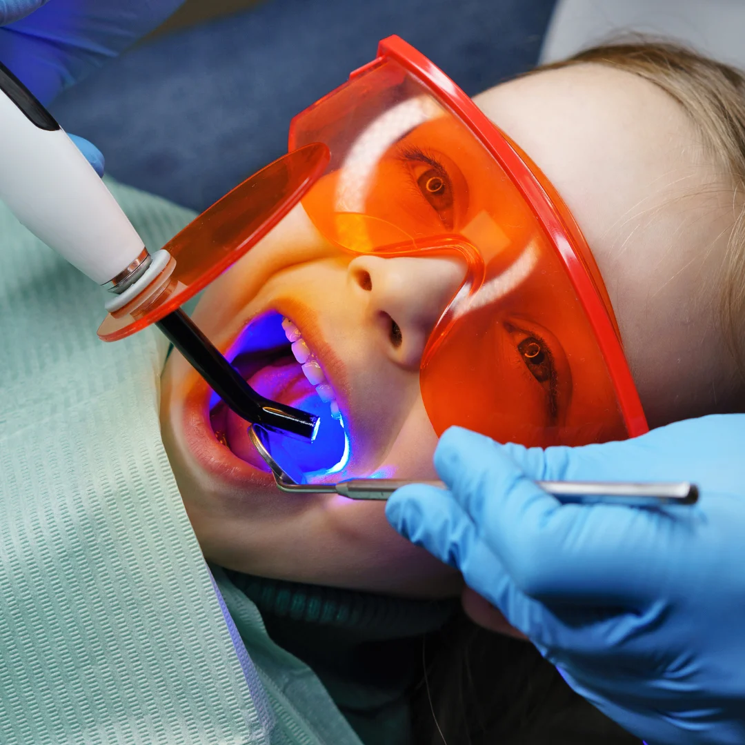 Dental filling treatment