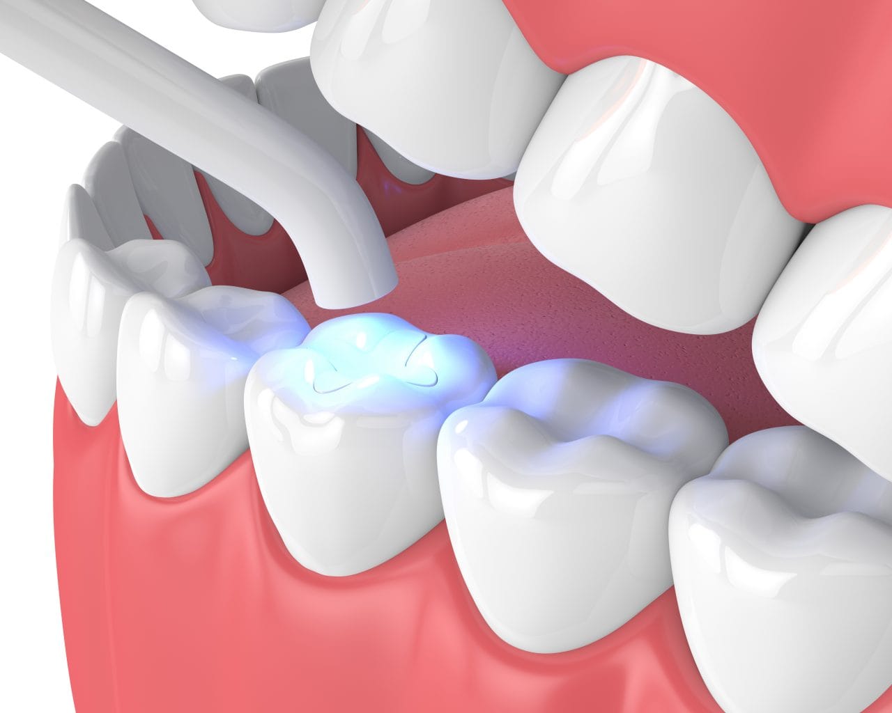Tooth coloured dental filling