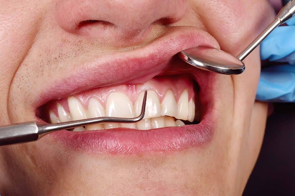Gum assessment dental examination