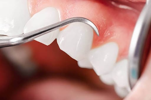Healthy gums dental care