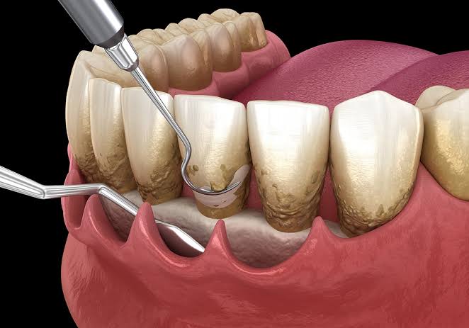 Periodontal gum treatment
