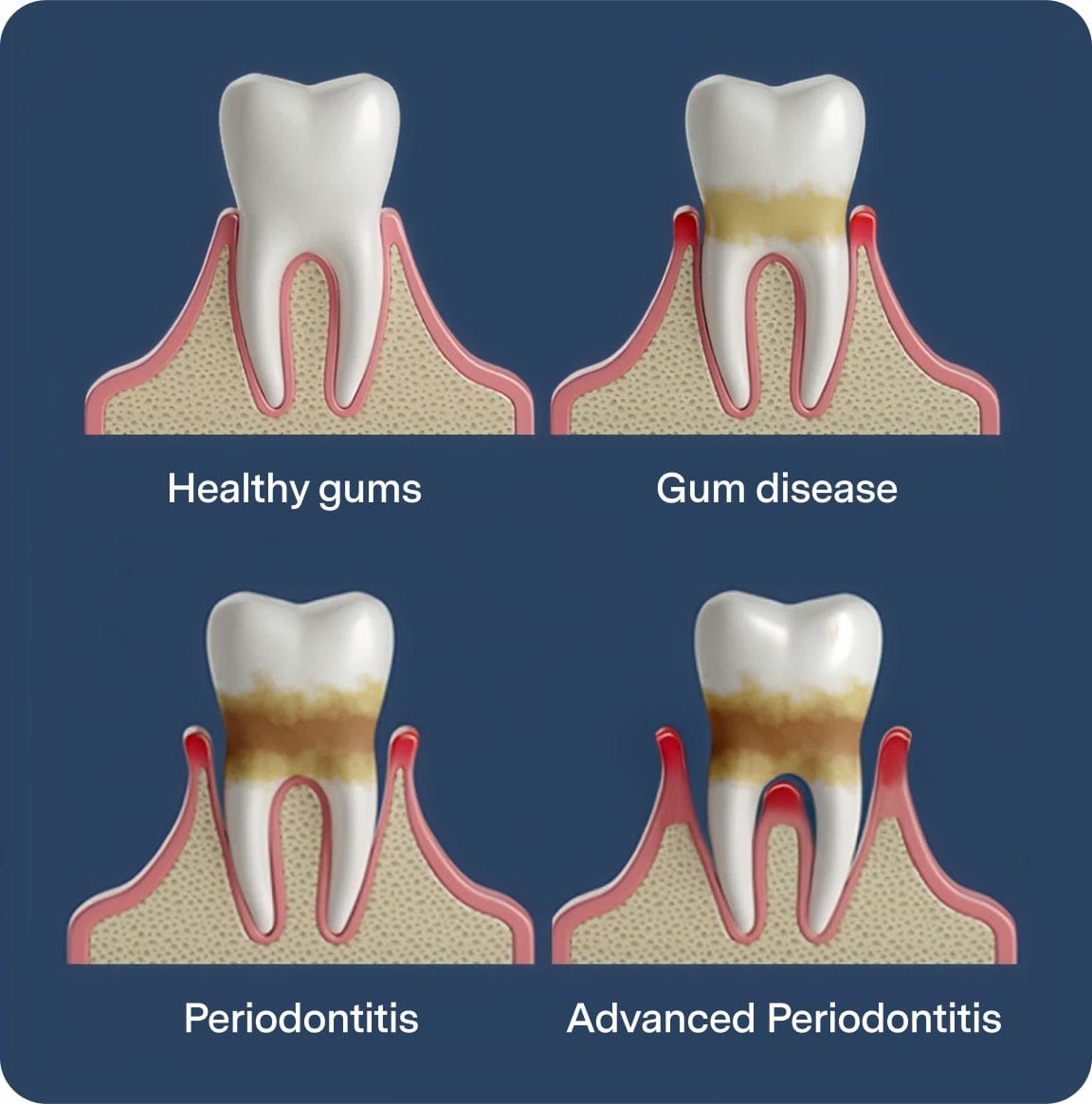 Gum disease progression