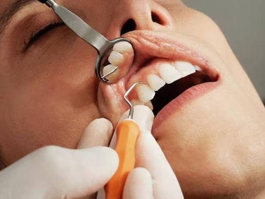 Professional dental scaling