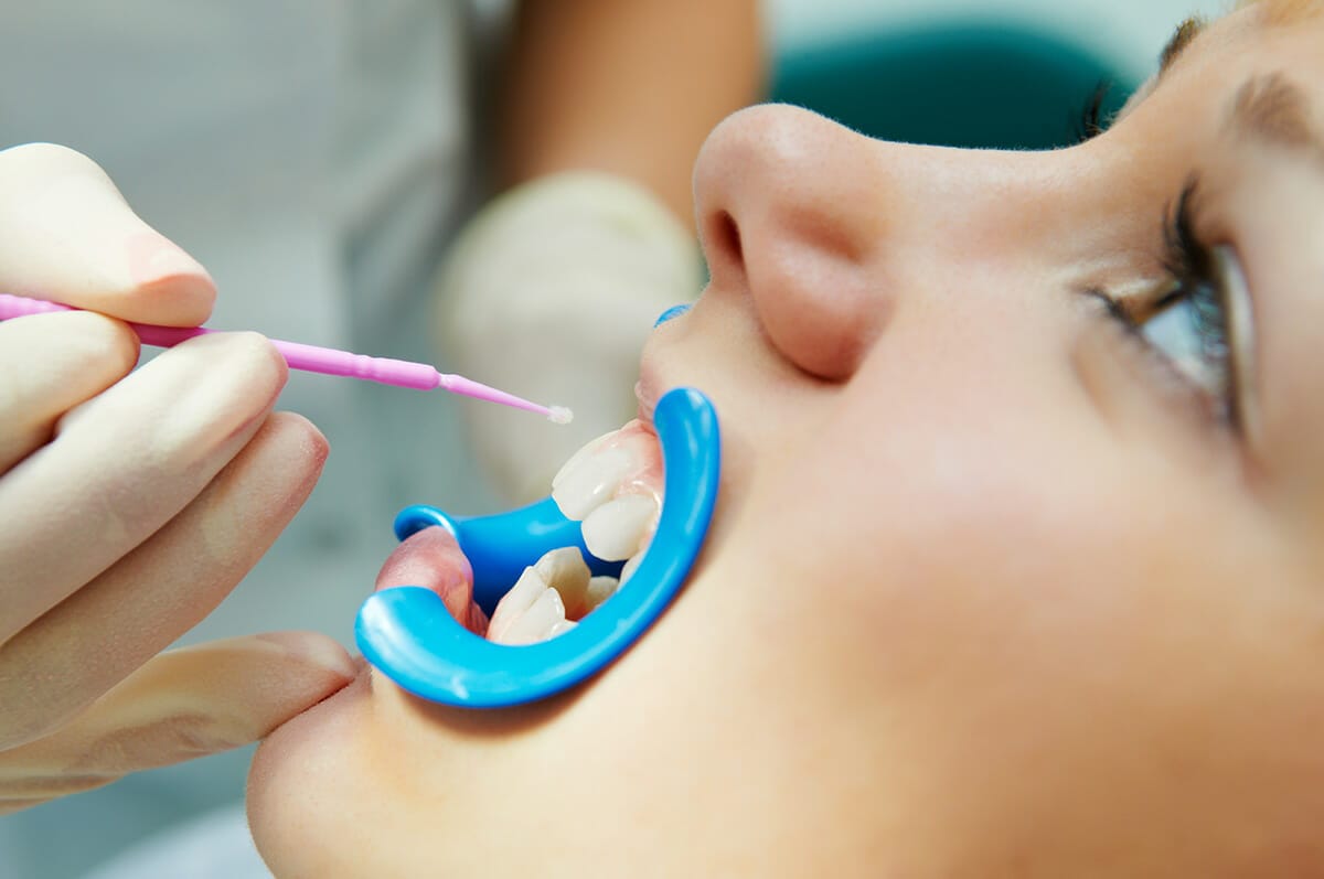 Dental sealant