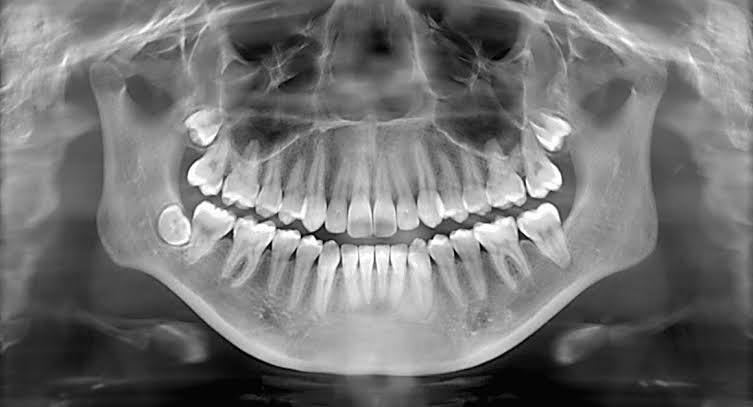 Dental X-ray diagnosis