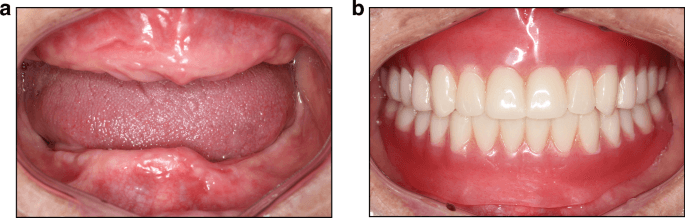 Denture smile restoration before and after