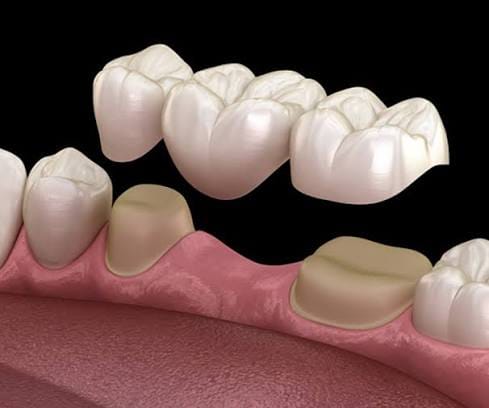 Dental bridge