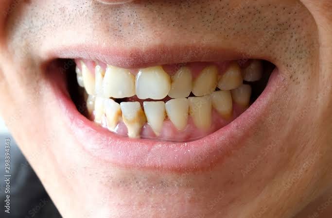 Dental calculus and tartar buildup
