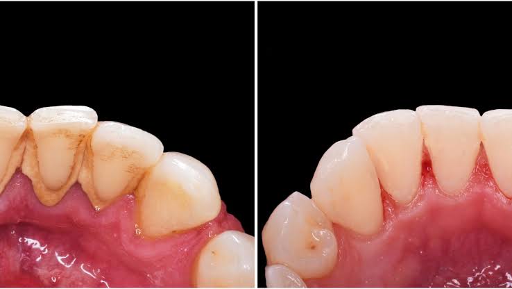 Clean healthy teeth after professional cleaning