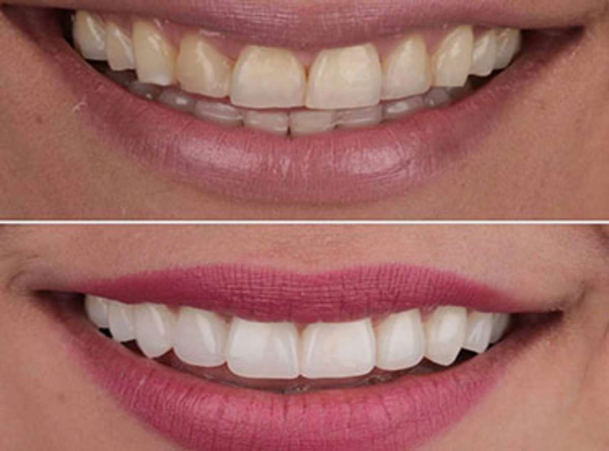 Porcelain veneers cosmetic dental treatment