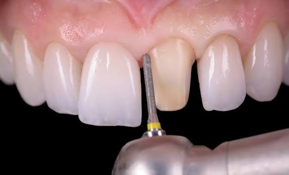 Dental crown preparation