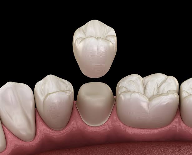 Dental crown