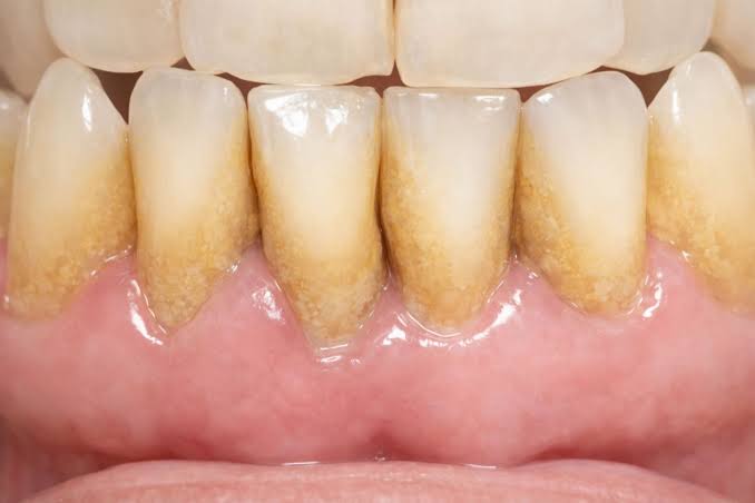 Dental gumline and tartar buildup