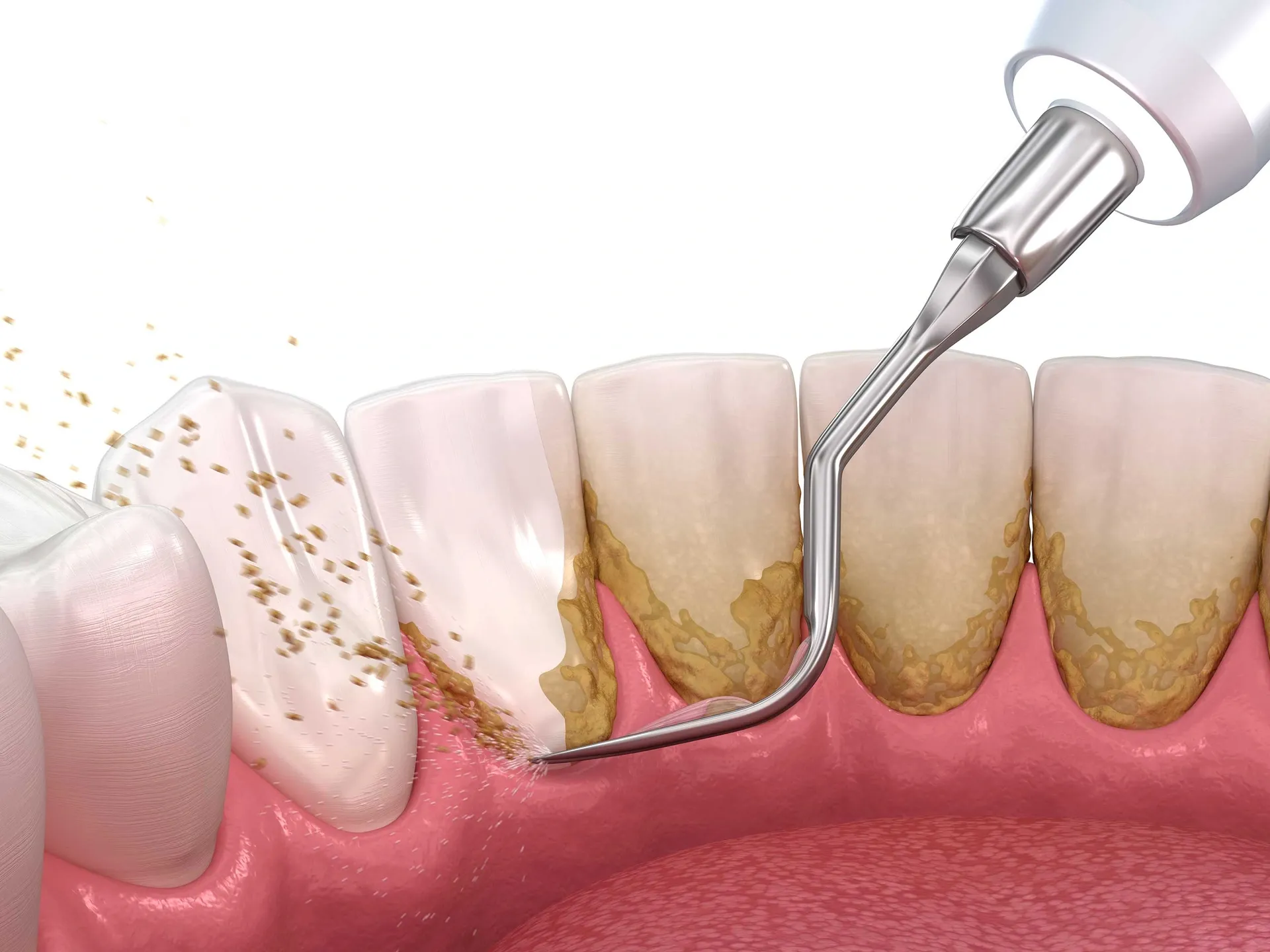 Professional dental scaling and cleaning