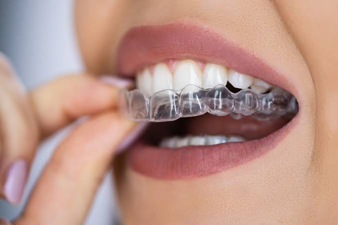 Clear aligner orthodontic treatment
