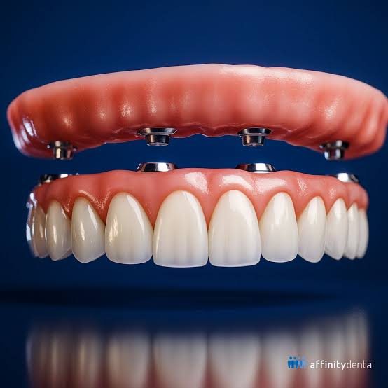Implant supported dentures