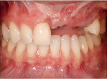 Multiple missing teeth