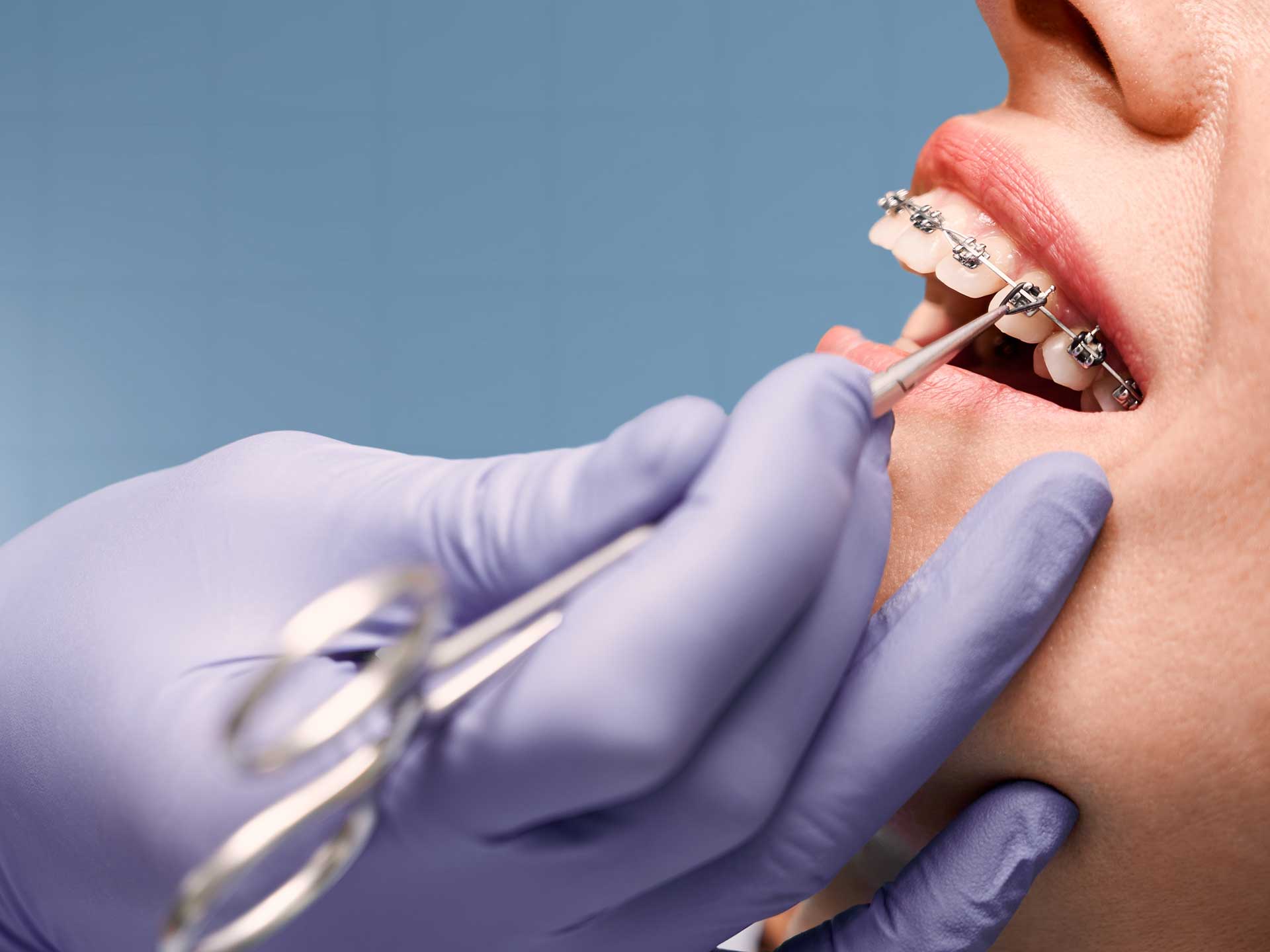 Orthodontic braces care