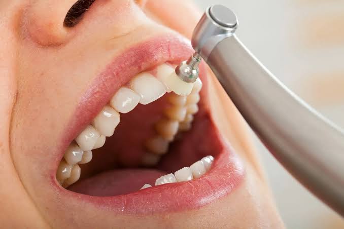 Professional dental polishing